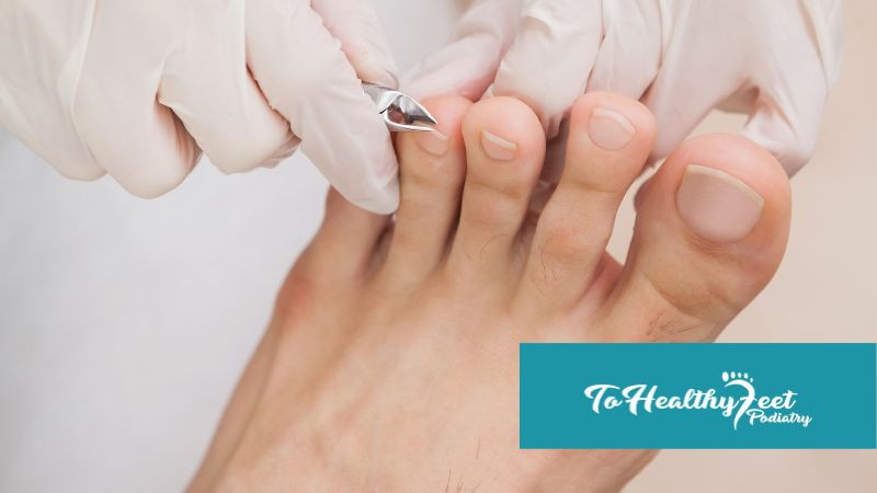  Ingrown Toenail Prevention for Runners and Athletes: Foot Care for Active Lifestyles